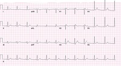 Unmasking of Brugada syndrome by lamotrigine in a patient with pre-existing epilepsy: A case report with review of the literature